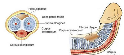 Peyronies Disease