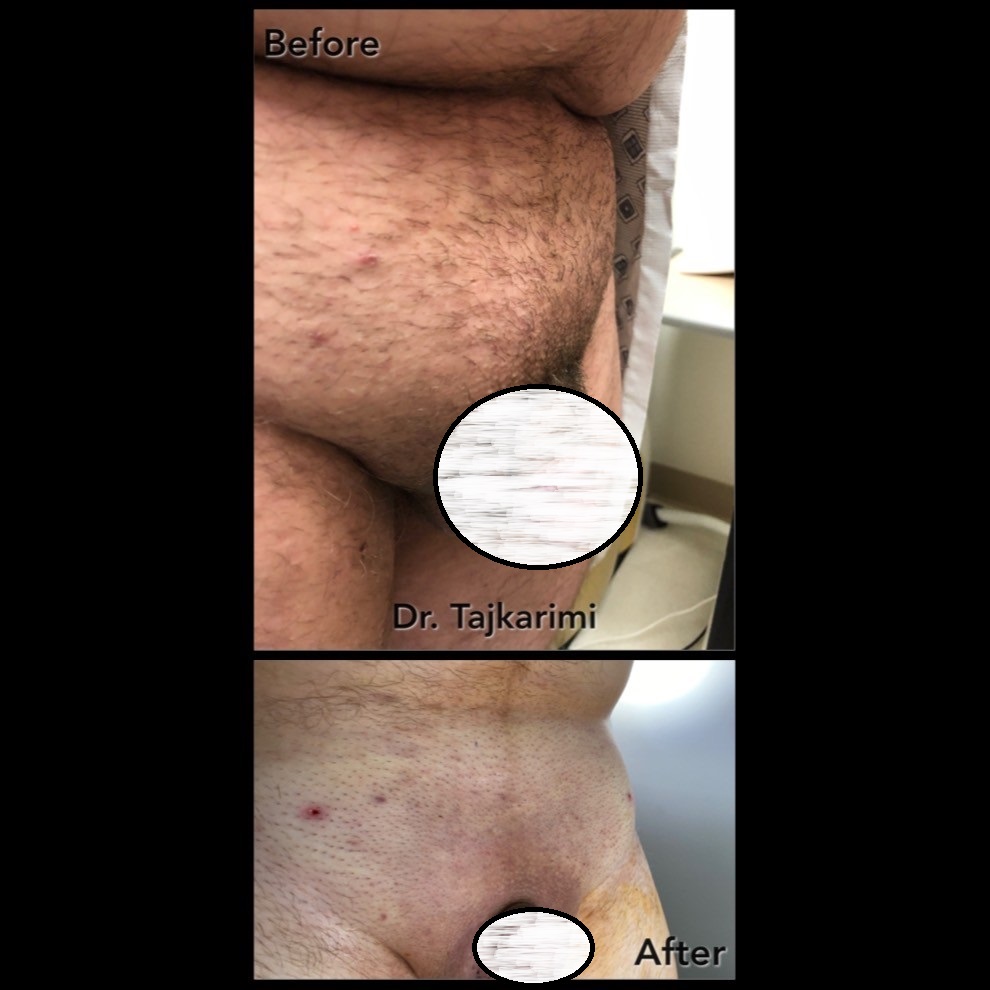 Awake Office Mons Liposuction & BodyTite (Scarless Monsplasty