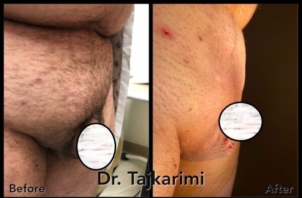 Tajkarimi Mons Lipo and bodytite 3 - Spartan Men's Health Clinic