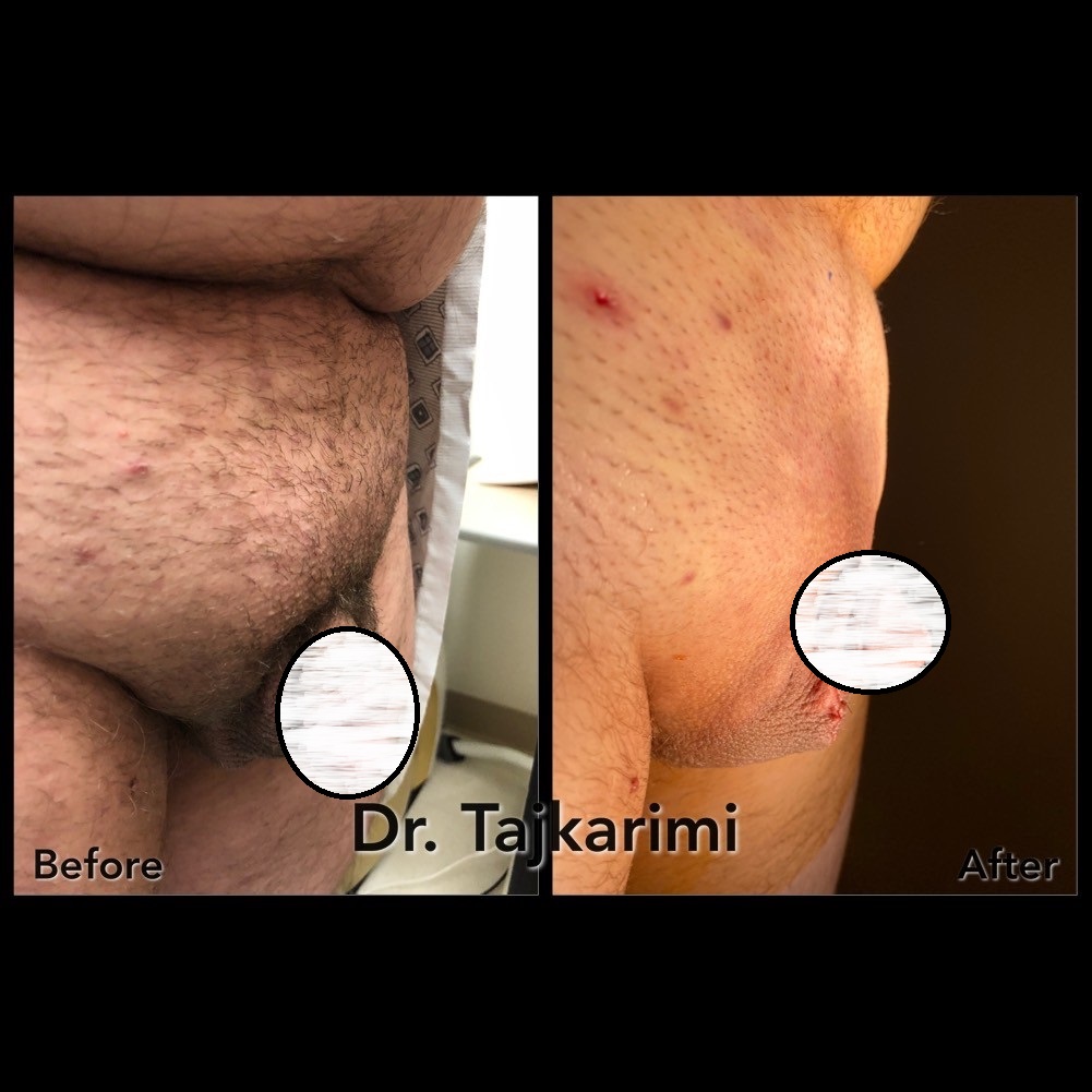 Awake Office Mons Liposuction & BodyTite (Scarless Monsplasty